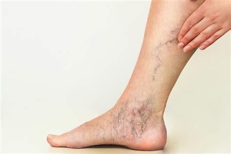 How To Treat Foot And Ankle Spider Veins Metro Vein Centers