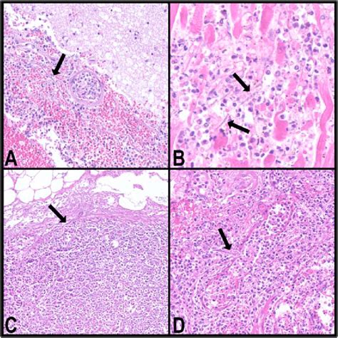 A Histopathological Of Brain Slide With Acute Abscess Inflammatory
