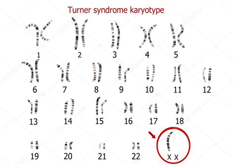 Turner Syndrome Karyotype Vector Image By Zuzanaa Vector Stock