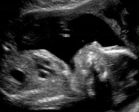 3d Ultrasound Pictures At 20 Weeks