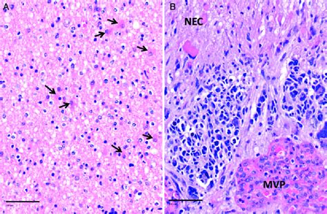 Astrocytoma In Low Grade A And High Grade B Stages A Low Grade