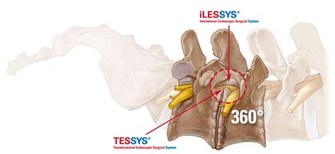 Endoskopische Bandscheiben Op Tessys Oder Ilessys Methode