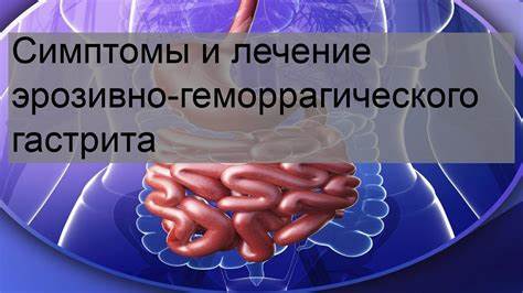 Симптомы и лечение эрозивно-геморрагического гастрита - YouTube Картинка - Симптомы и лечение эрозивно-геморрагического гастрита - YouTube