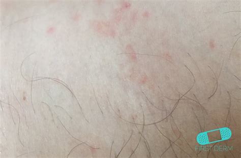 Learn more about herpes skin rashes here. Online Dermatology - Herpes Zoster (Shingles)