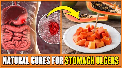 5 Natural Cures For Stomach Ulcers Youtube