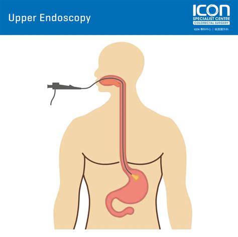 Upper Endoscopy Ogd Icon Specialist Centre
