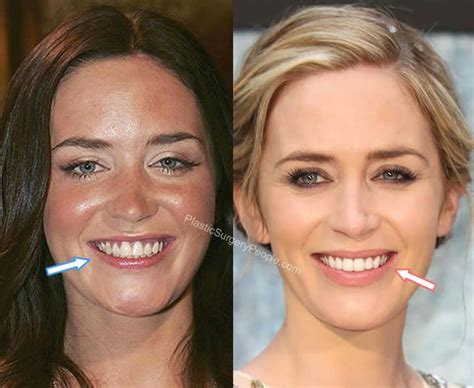 Did Emily Blunt Have Plastic Surgery In Plastic Surgery Boob