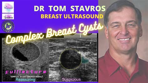 Breast Cysts That Arent Simple Dr Tom Stavros Breast Ultrasound