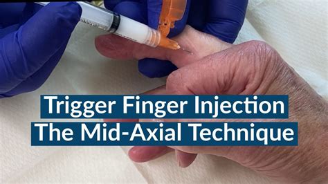 Trigger Finger Injection The Mid Axial Approach Youtube