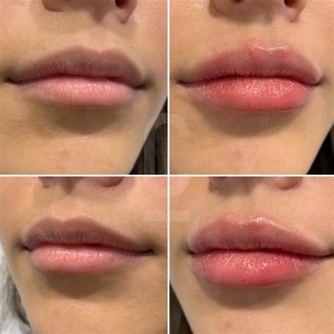 Lip Filler Migration The Most Important Things You Need To Know Cosmetic Connection