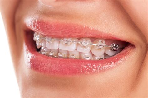 The first few days after your orthodontist puts understand how to get through the first few days with braces. Braces or Invisalign? How to Know Which to Choose - Fun ...