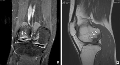 Magnetic Resonance Imaging From Left Knee Preoperatively A Coronal T2