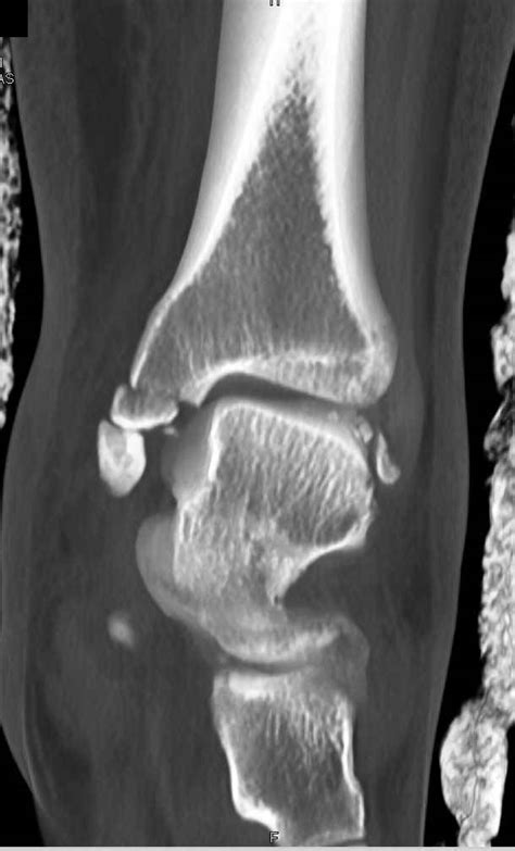 Ankle Fracture Including Talus Fracture Trauma Case Studies Ctisus