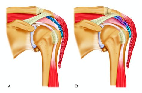 The shoulder is made up of three bones: Polishuk Physical Therapy Wellness & Fitness | Excellence in Physical Rehabilitation ambler ...