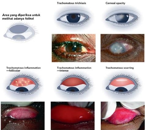 Diagnosis Trachoma Alomedika