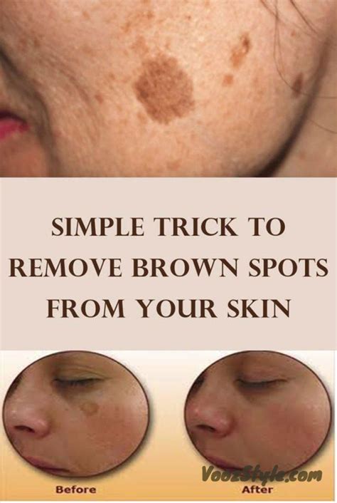 There Is Nothing Scary With Having A Few Brown Spots Also Known As Age Spots But Things Get