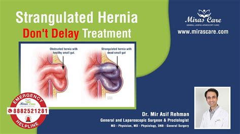 Strangulated Hernia Don T Delay Treatment Dr Mir Asif Rehman DNB General Surgery