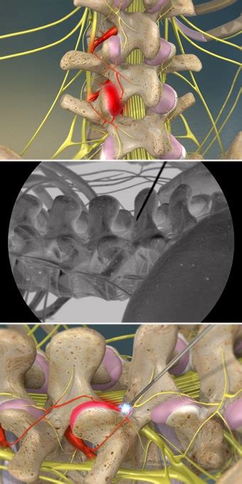 Radiofrequency Neurotomy Of The Lumbar Facets Pain Specialists Of