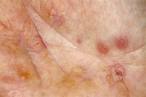 Eczema Stock Image M1500333 Science Photo Library