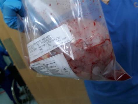 Iyyāka na'budu wa iyyāka nasta'īn. Berat Dugaan Wanita Ini, Setelah 2 Minggu Disahkan Ovarian ...