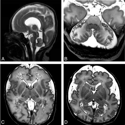 Characteristic Mr Imaging Findings Of The Neonatal Brain In Rasopathies