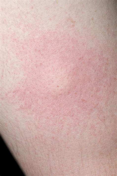 Mosquito Bite Allergy Face