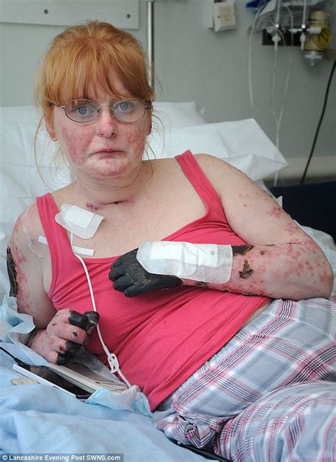 Blackpool Mother Faces Triple Amputation After Body Was Ravaged By
