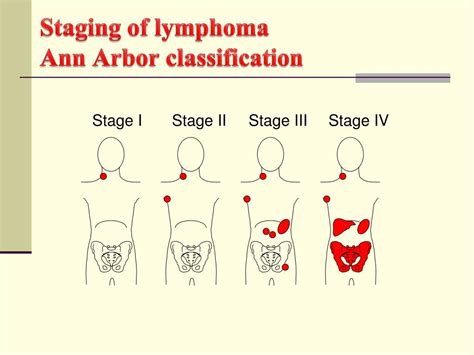 Ppt Lymphomas Powerpoint Presentation Free Download Id6599154