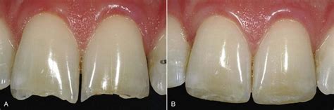 9 Direct Composite Restorations Pocket Dentistry