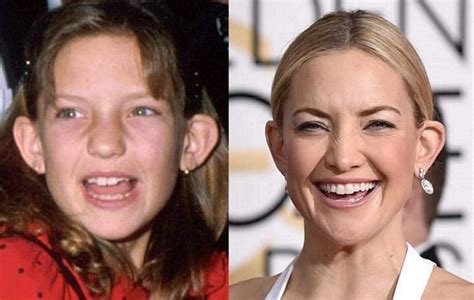 Kate Hudson Before And After Plastic Surgery Boob Nose Teeth