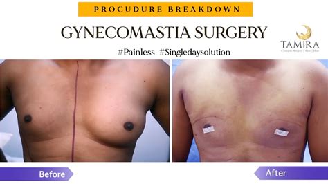 Gynecomastia Surgery In Chennai I Puffy Nipple And Male Chest Reduction