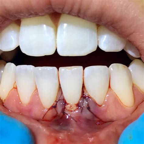 24 Autogenous Connective Tissue Graft The True Life Of A Dental