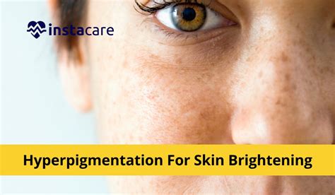 10 Home Remedies For Hyperpigmentation For Skin Brightening