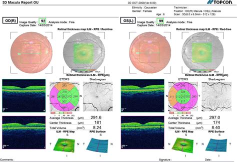 bilateral macular optical coherence tomography report of a 6 year old girl download scientific