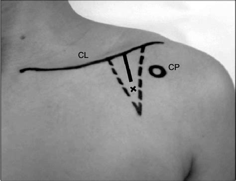 Landmarks For Brachial Plexus Block Cl Clavicle Cp Coracoid