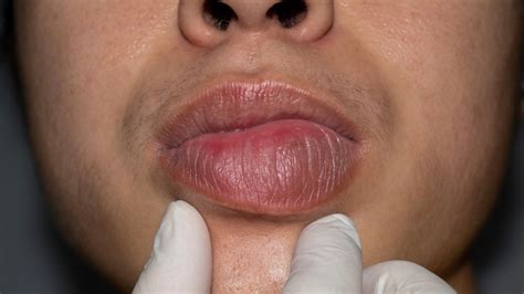 Angioedema Causes Types And Treatments