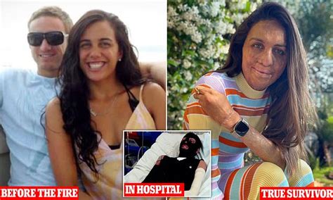 Turia Pitt Says Her Dad Stopped Her From Committing Suicide After She Was Badly Burnt In Wildfire