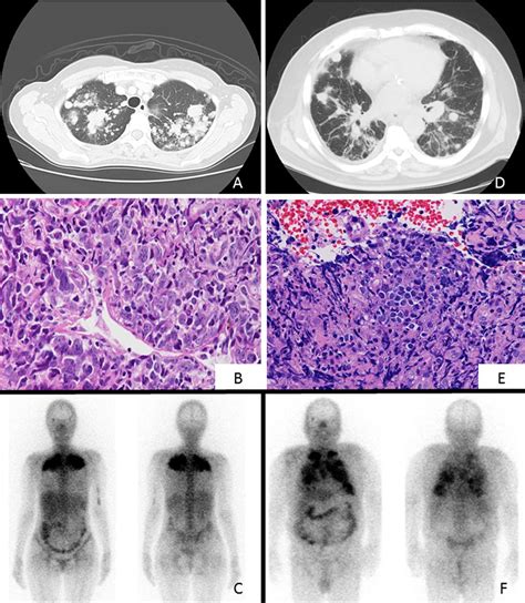 Unique Radiological Features Of Two Cases Of Primary Pulmonary Diffuse