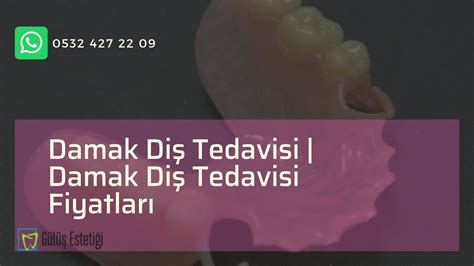 Damak Diş Tedavileri | Damak Diş Tedavisi Fiyatları Ankara