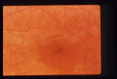 Fundus Flavimaculata Stargardts Retina Image Bank