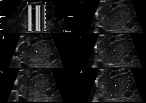 Tui Tomographic Ultrasound Imaging Longitudinal Section Of A Female