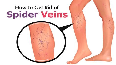 How To Get Rid Of Spider Veins Naturally Spider Veins Treatment Home Remedies For Spider