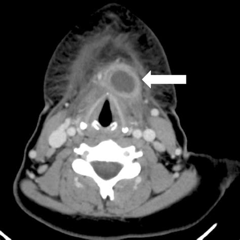 Pdf Infected Thyroglossal Duct Cyst