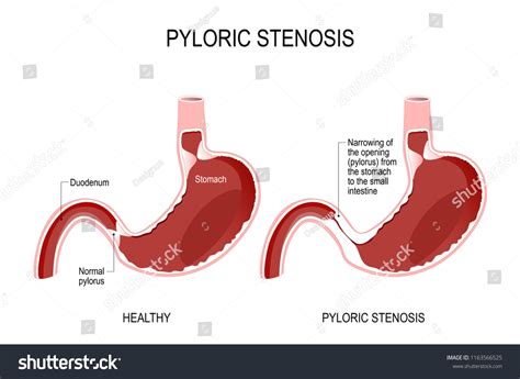 Pyloric Stenosis Narrowing Opening Pylorus Stomach Stock Vector