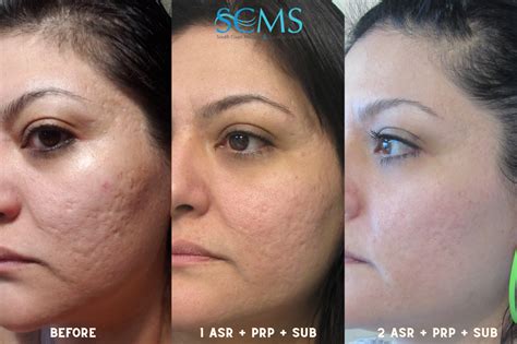 Acne Scar Removal Before And After With Prp And Subcision Laser
