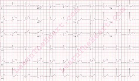 Inferior Posterior Wall Mi Ecg Example 1 Learn The Heart