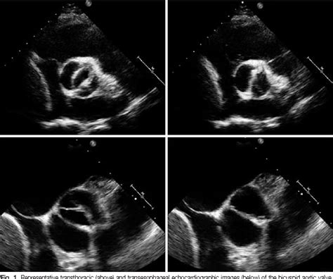 Figure 1 From Bicuspid Aortic Valve Unresolved Issues And Role Of Imaging Specialists