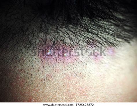 Inflamed Pus Pimples On Head Scalp Stock Photo Edit Now 1725623872