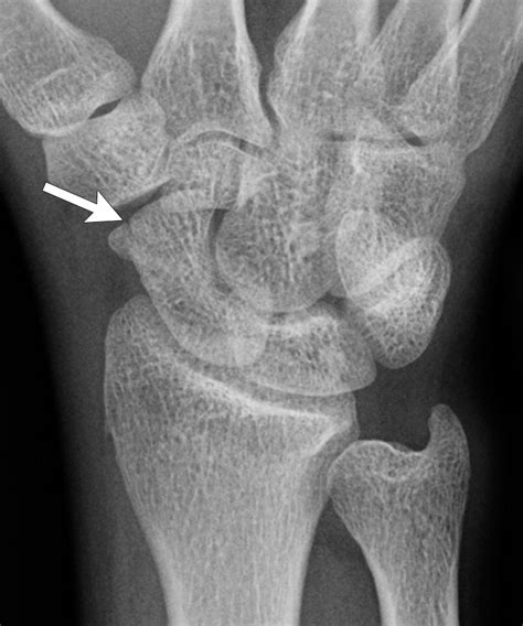 Pediatric Distal Forearm And Wrist Injury An Imaging Review