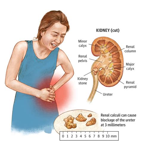 Kidney stones may form when there's a change in the normal balance of the water, salts, and minerals found in urine. Major Kidney Stone Symptoms - Tests and Treatments - Dr ...